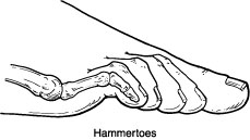 treatment for hammer toes, surgery
