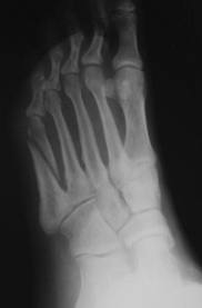 Your Broken Foot May Be Due To Osteoporosis